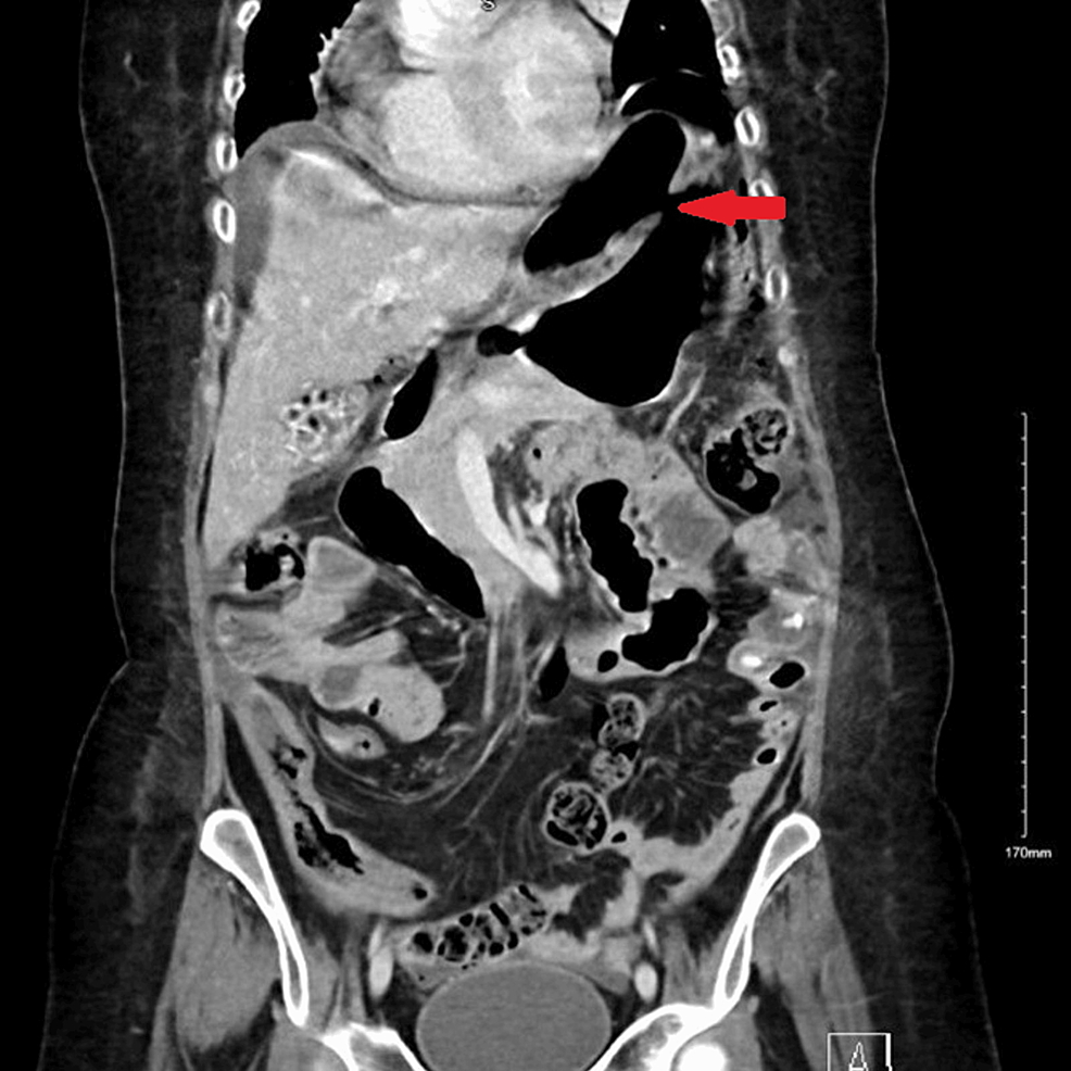 Coronal-section-CT-image-of-abdomen-and-pelvis-at-the-time-of-gastric-perforation-showing-features-of-gastric-perforation-likely-related-to-the-underlying-perforated-peptic-ulcer-with-0.8-cm-defect-at-the-distal-greater-curvature-