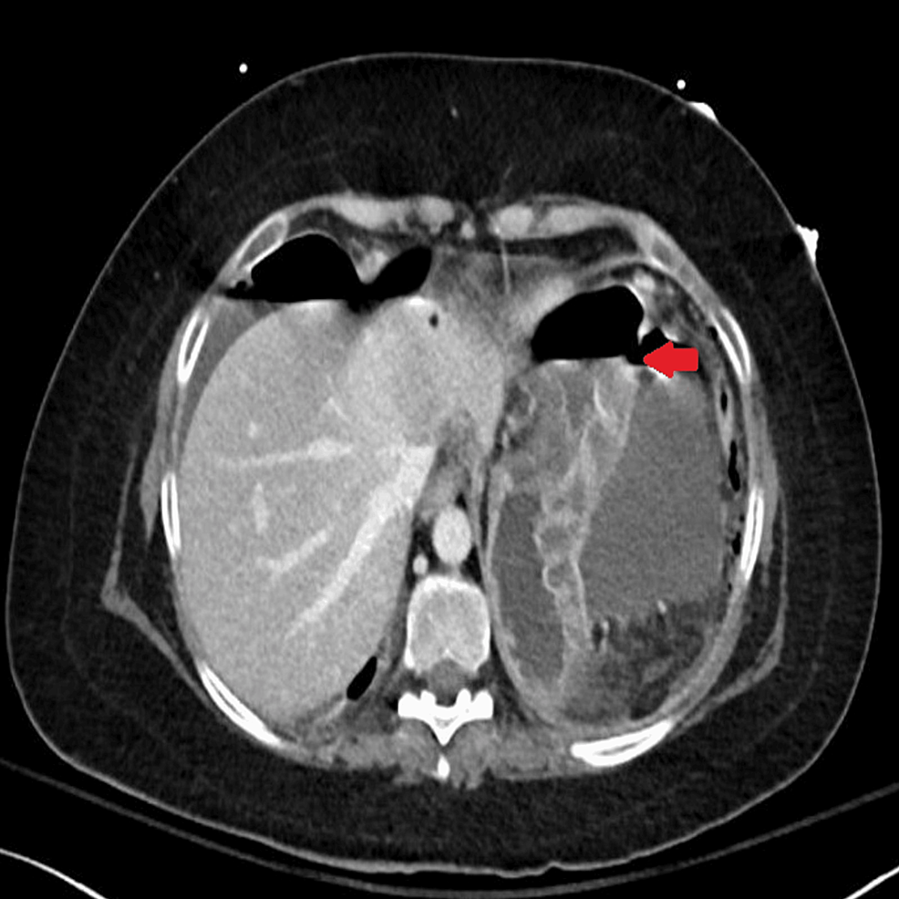 Horizontal-section-CT-image-showing-features-of-gastric-perforation-likely-related-to-the-underlying-perforated-peptic-ulcer-with-0.8-cm-defect-at-the-distal-greater-curvature