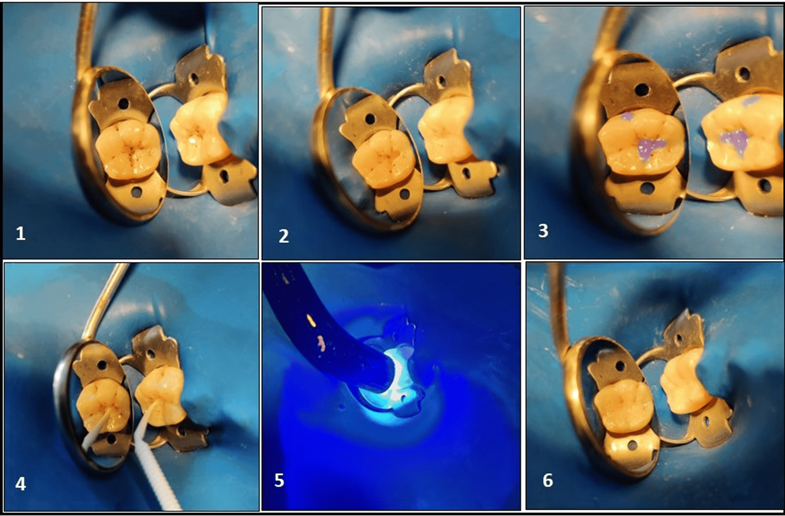 Clinical Assessment of Moringa oleifera as a Natural Crosslinker for