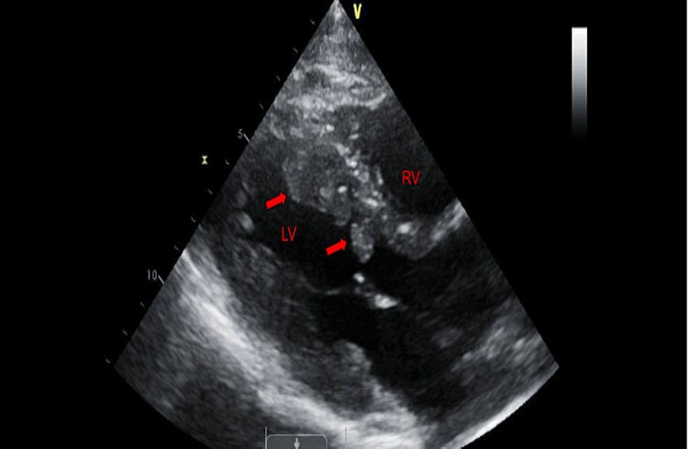 melanotic sarcoma of heart Cardiac Tumor: Types, Symptoms & Treatment Cardiac tumours: diagnosis and management