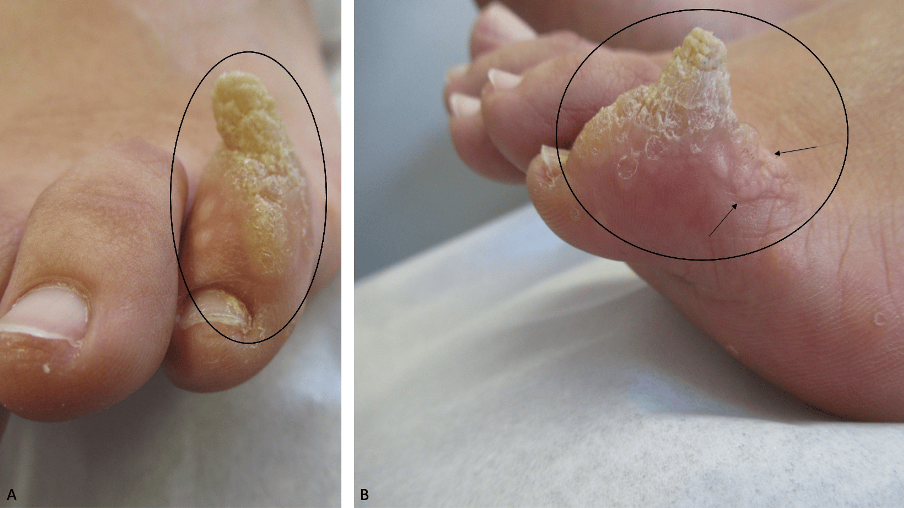 Cornu Cutaneum Case Reports of Patients With a Cutaneous Horn