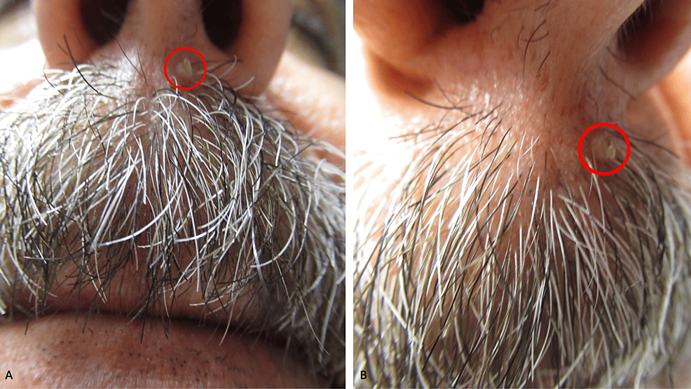 Cornu Cutaneum Case Reports of Patients With a Cutaneous Horn