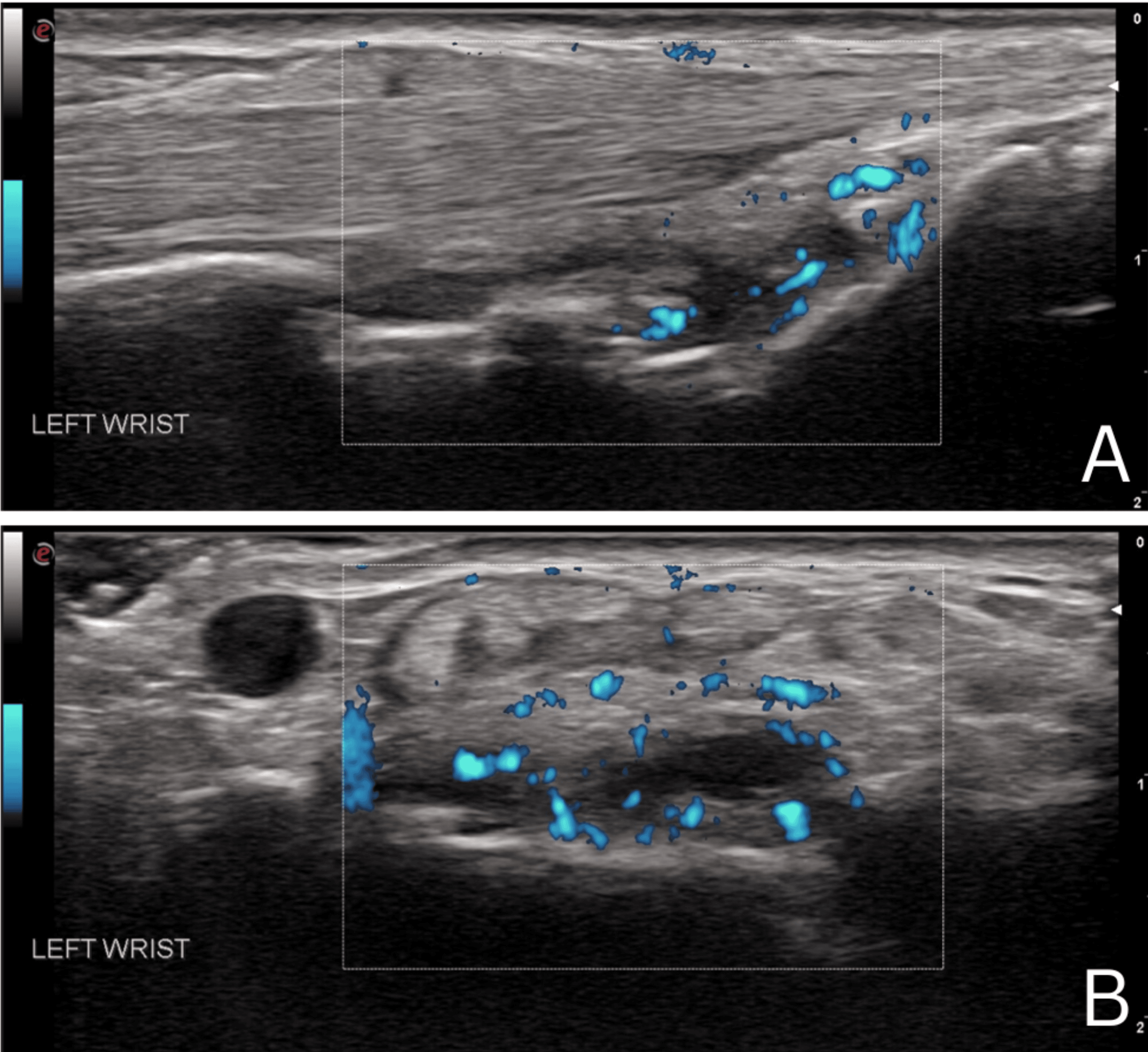 Cureus | The Importance of Ultrasound-Guided Synovial Biopsy in the ...