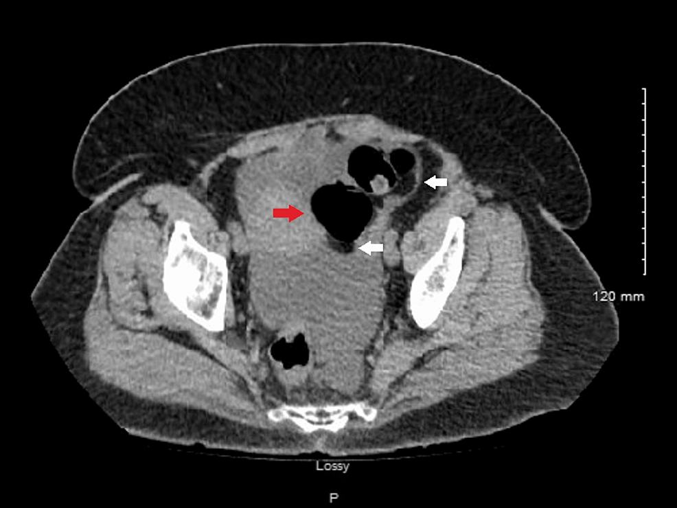 A Case of Angiotensin-Converting Enzyme (ACE) Inhibitor-Induced Small ...