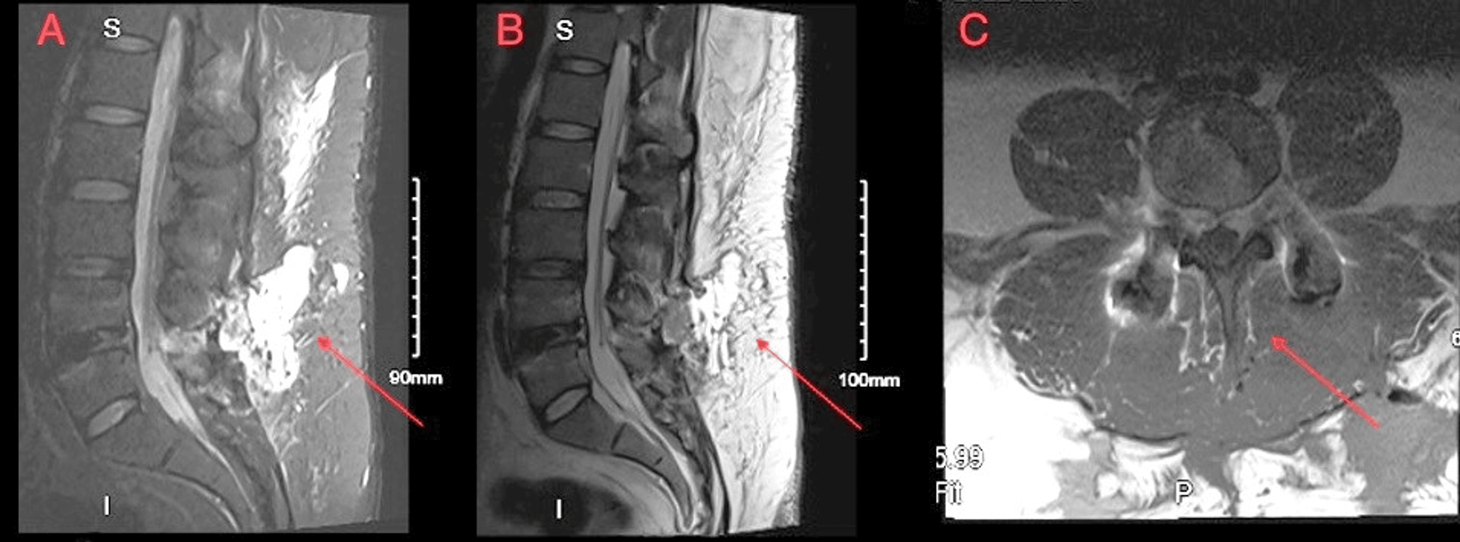 Cureus Management of Superrefractory Postoperative Lumbar