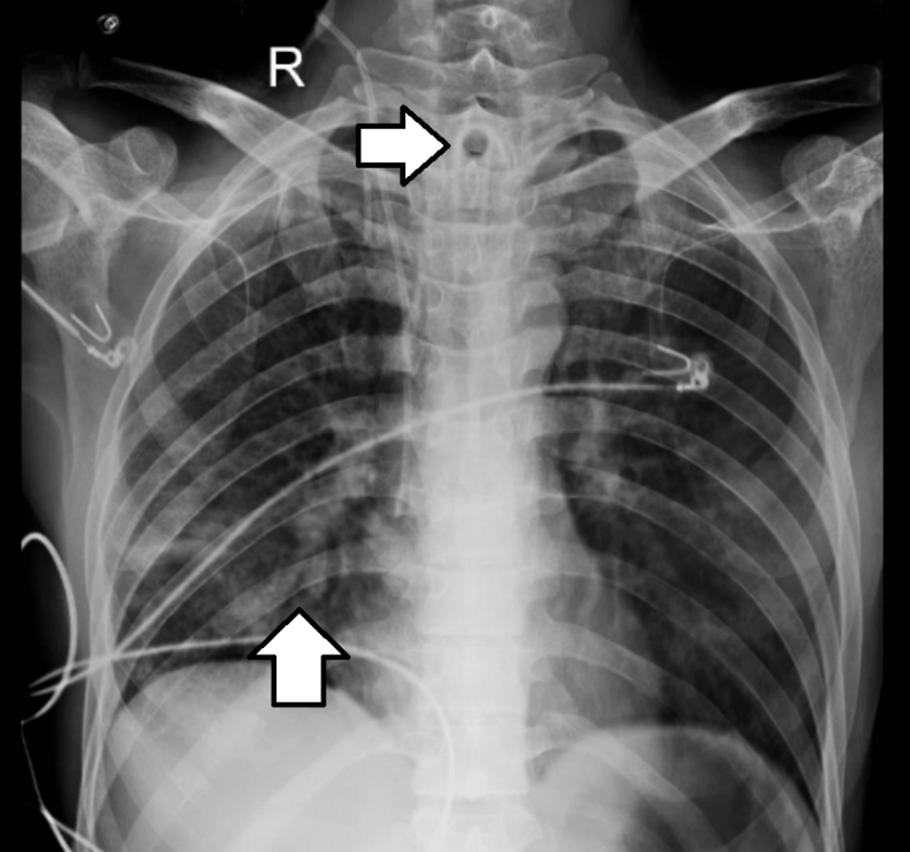 Resurgence to Life A Case Report on Inpatient Rehabilitation in