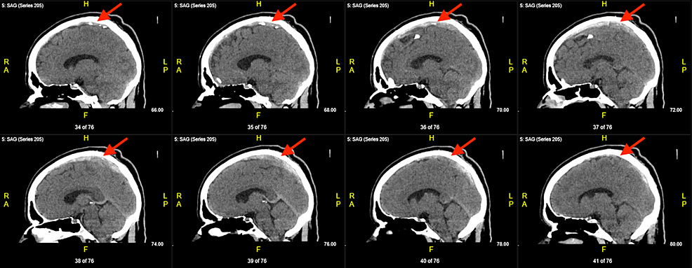 Cureus Superior Sagittal Venous Sinus Thrombosis In A Patient With