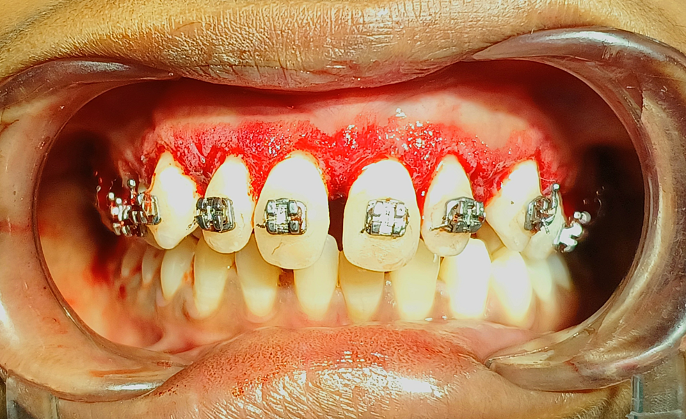Cureus Management of OrthodonticInduced Gingival Enlargement A Case