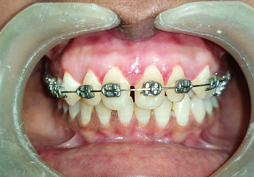 Cureus Management of OrthodonticInduced Gingival Enlargement A Case Report