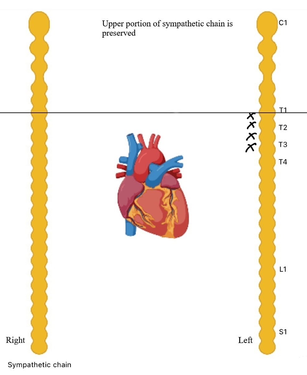 Cureus | Unlocking The Potential Of Left Cardiac Sympathetic ...