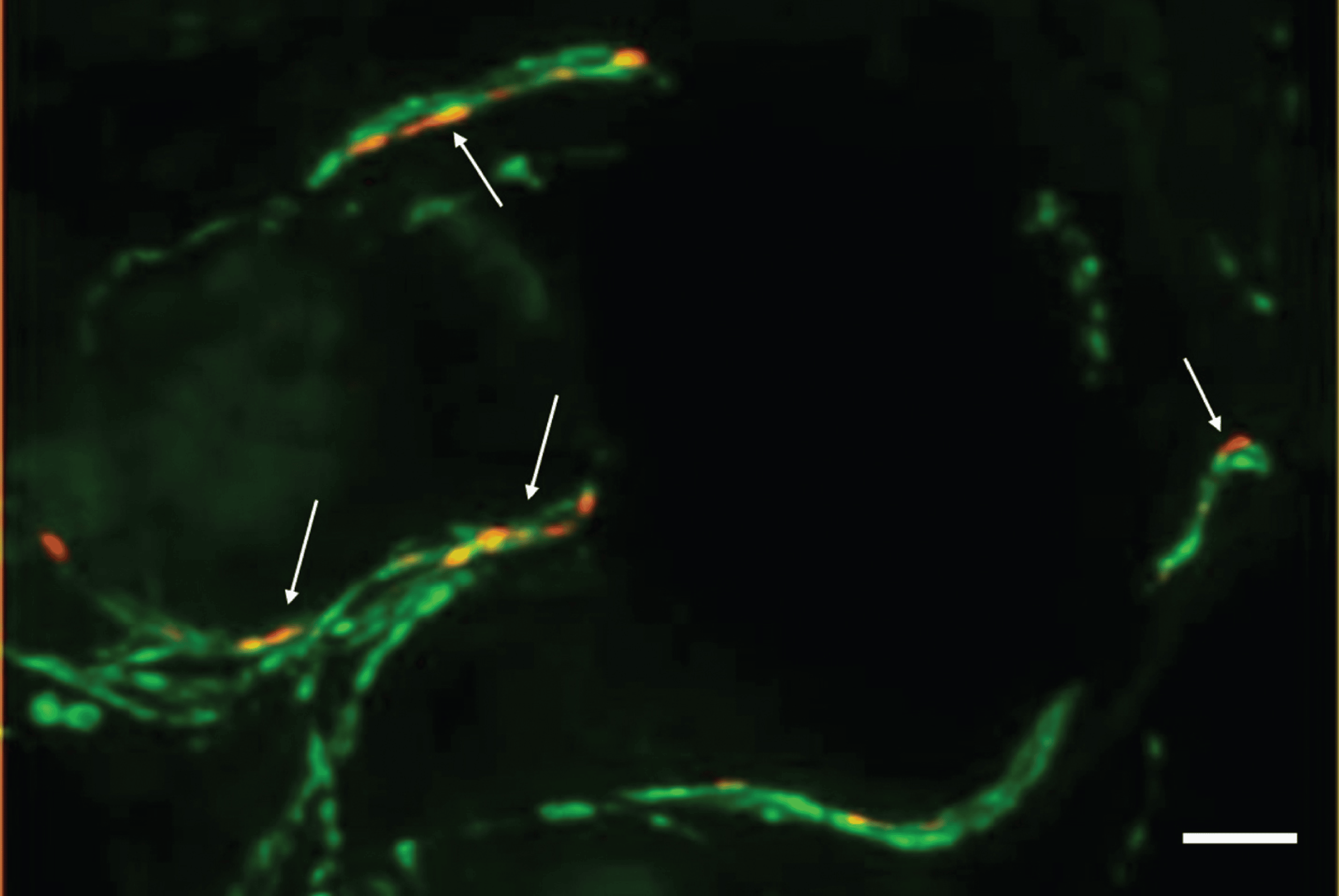 Skin Biopsy As A Diagnostic Tool For Synucleinopathies Cureus