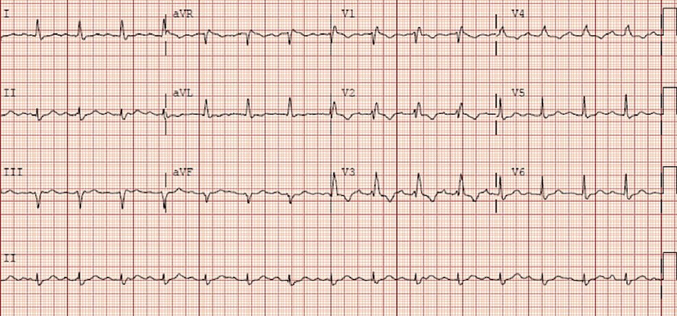 Cureus | A Chest Pain Conundrum: Dapsone-Induced Methemoglobinemia in a ...