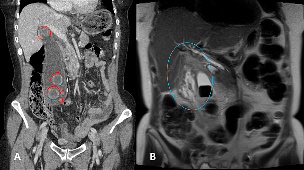 Abdominal-computed-tomography-(CT)-scan