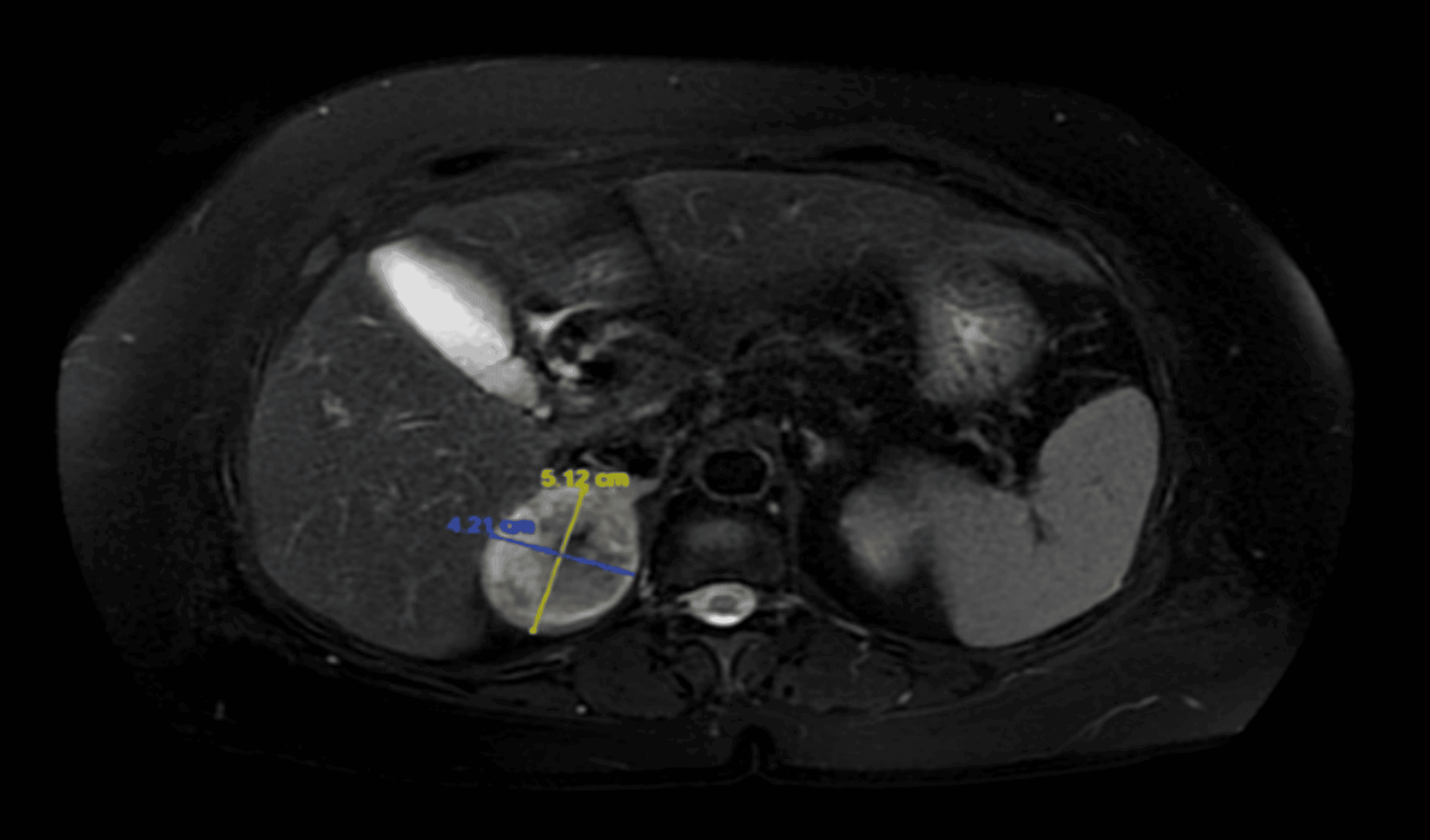 Cureus Primary Adrenal and its Management A Case Report