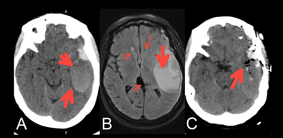 Figure 1 from Brain surface temperature under a craniotomy.