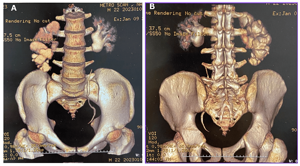 File:Iliac crest 02 - posterior view.png - Wikimedia Commons