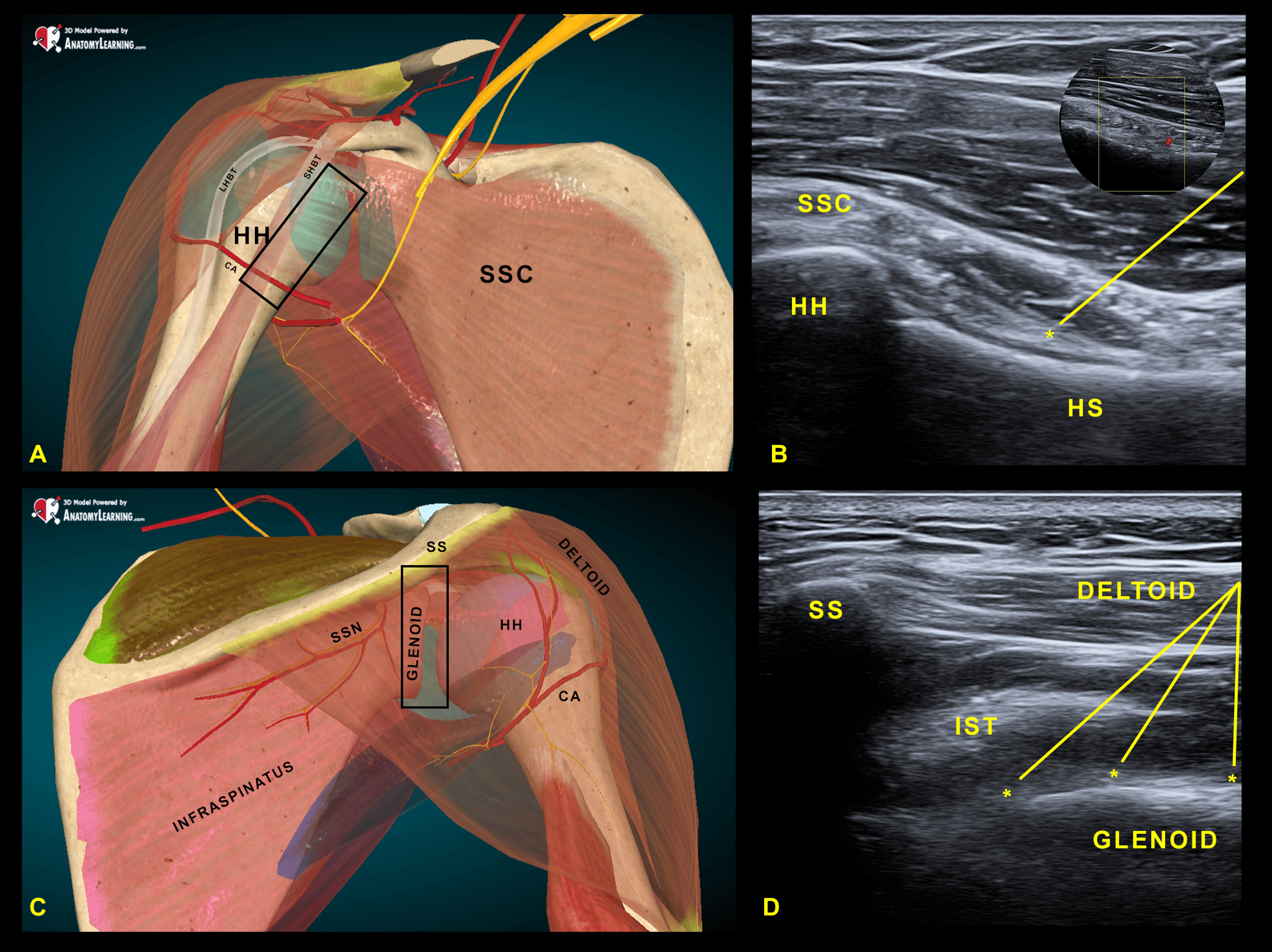Cureus Phenolysis for Advanced Shoulder Osteoarthritis A Case Series