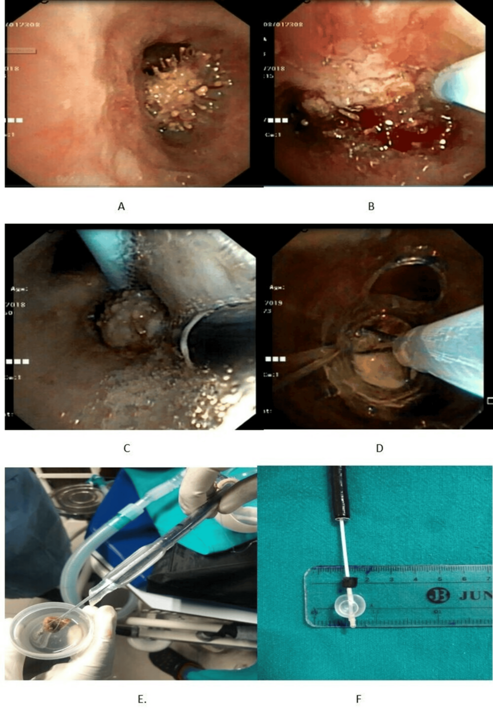 Navigating Challenges in Adult Airway Foreign Body Extraction 