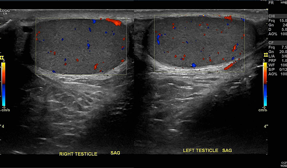 Doppler-imaging-showing-bilateral-arterial-and-venous-flow-within-testes