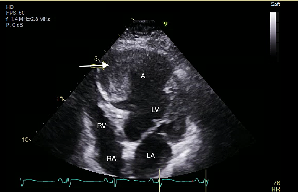 Cureus | Incidental Left Ventricular Aneurysm Discovered after Chest ...