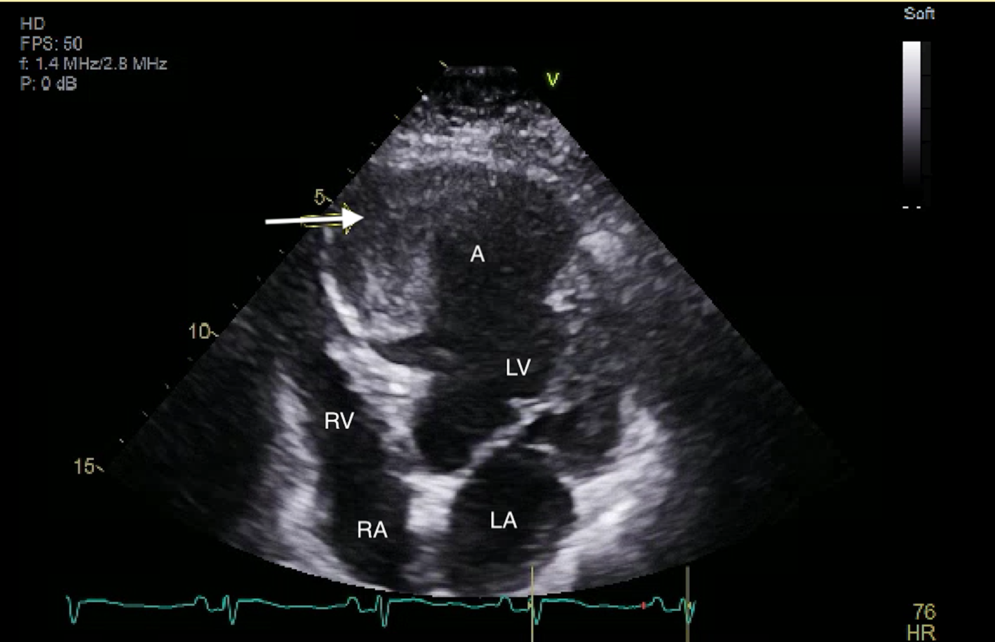 Cureus Incidental Left Ventricular Aneurysm Discovered