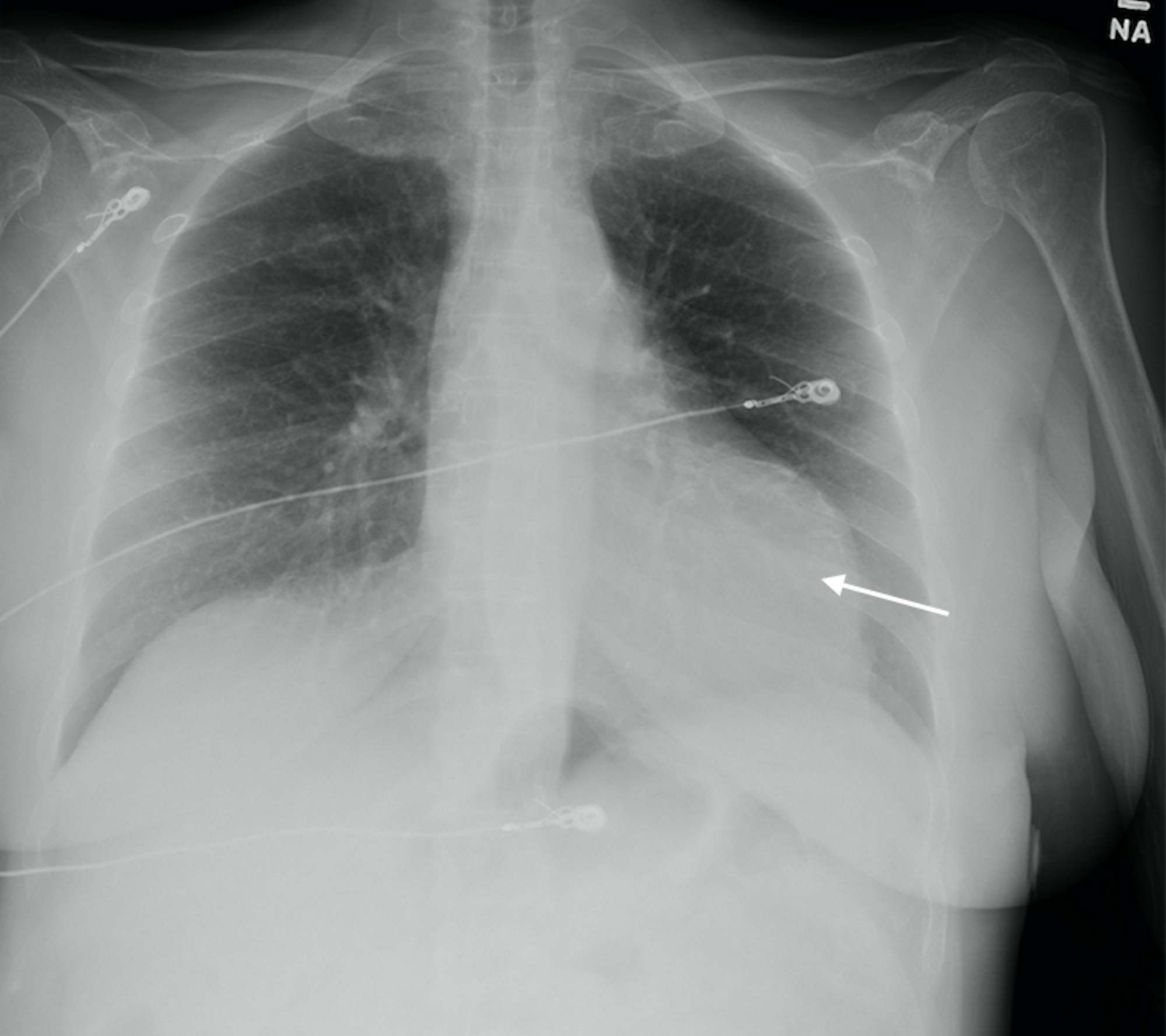 Cureus | Incidental Left Ventricular Aneurysm Discovered after Chest ...