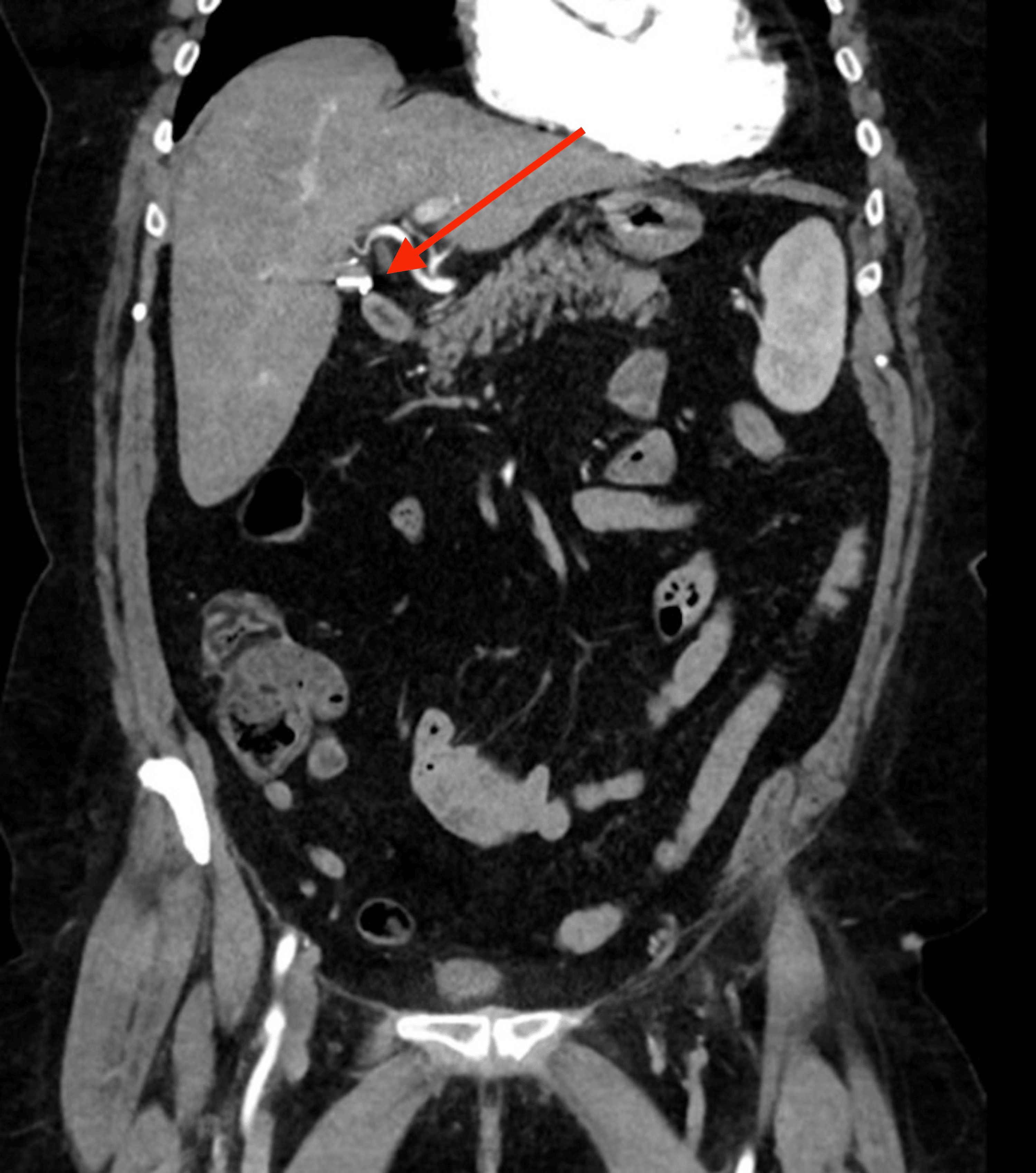 Migrated Laparoscopic Surgical Clips Causing Acute Cholangitis 32 Years