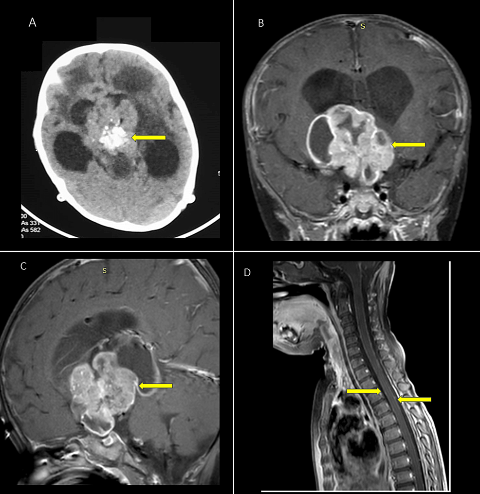 ASDAS states in patients stratified by baseline MRI/CRP status.