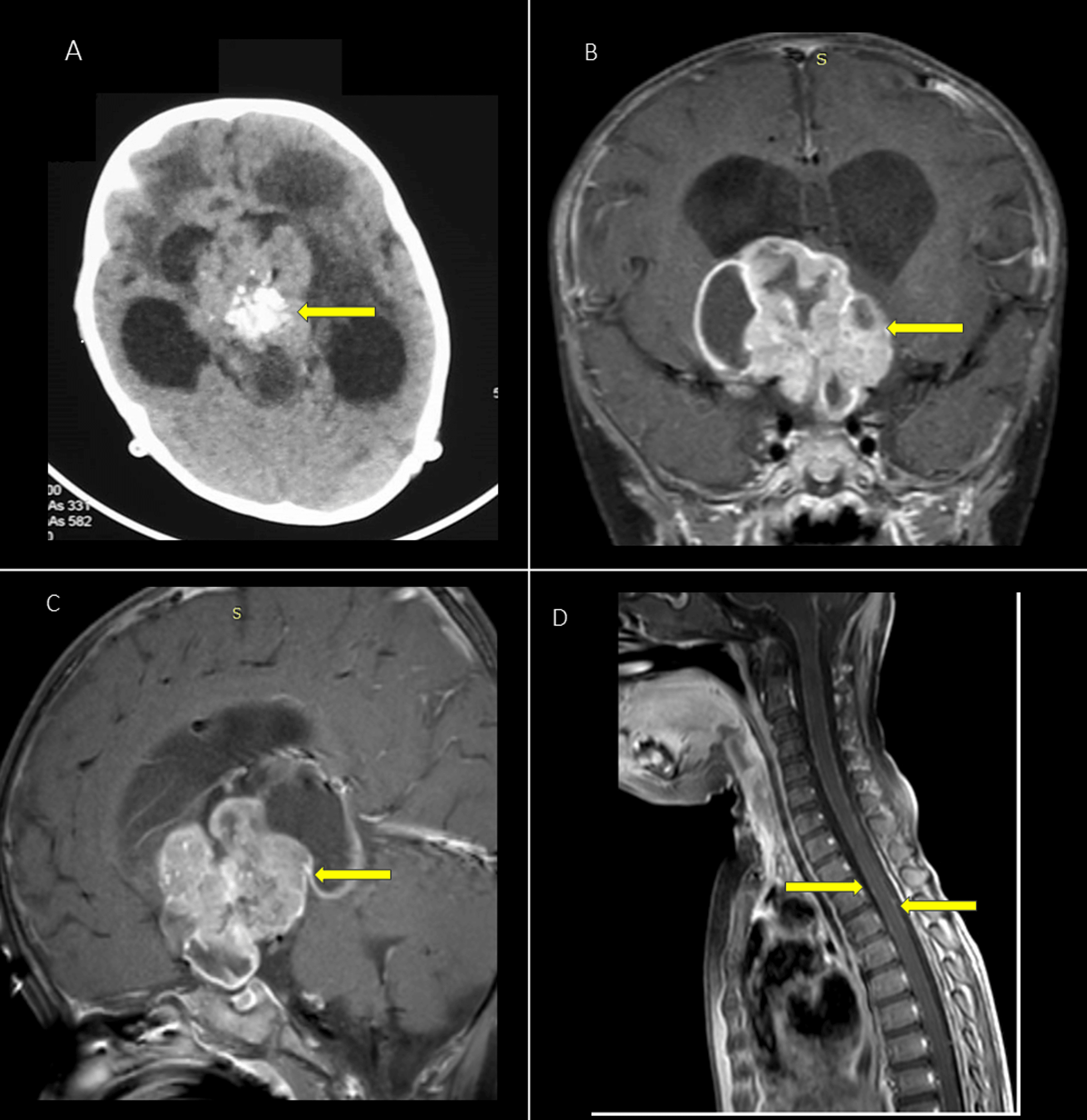 Sellar Suprasellar Surprise: A Rare Case Of Atypical Teratoid/Rhabdoid ...