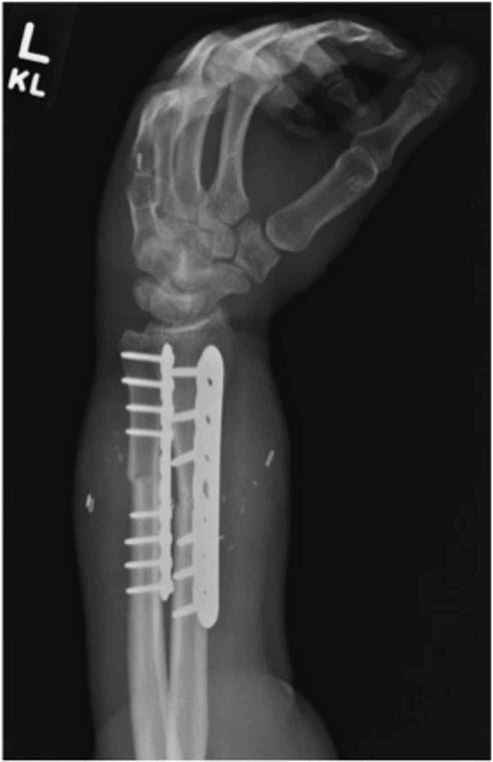 Oblique-X-rays-after-plating