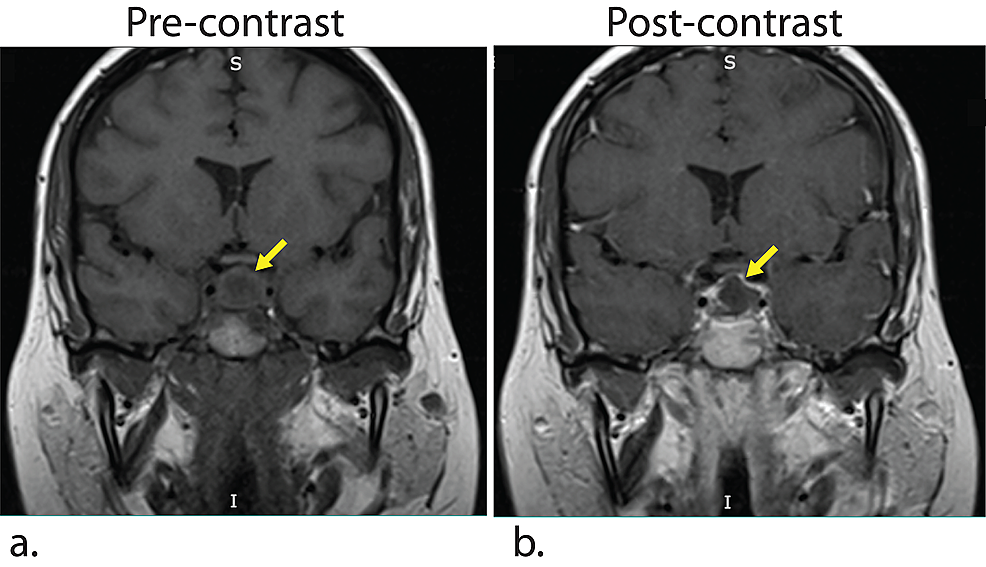 Granulomatosis with Polyangiitis Manifesting as a