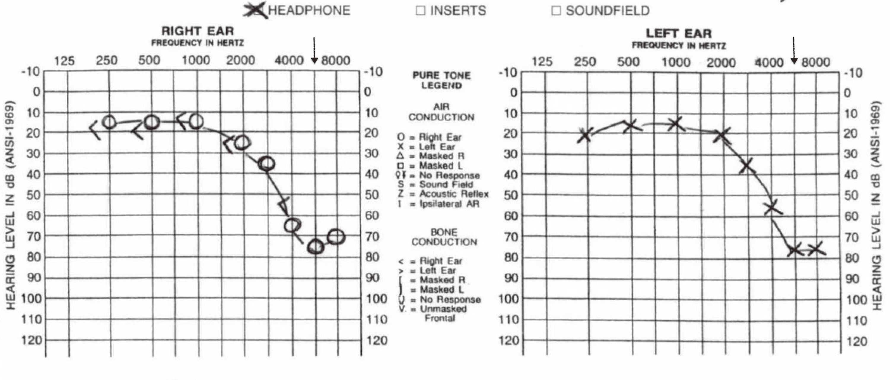 Sensorineural Hearing Loss as a Complication of COVID19 and the COVID