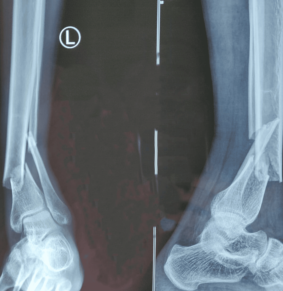 Cureus Comparative Study of the Management of Distal Tibia Fractures