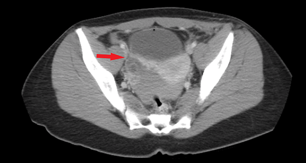 Cureus  Large Haemoperitoneum Caused by a Ruptured Endometrioma