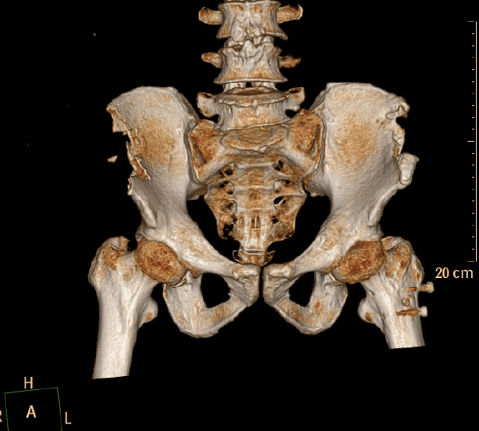 Cureus, Caecum Rupture Secondary to Iliac Crest Bone Graft: A Case Report