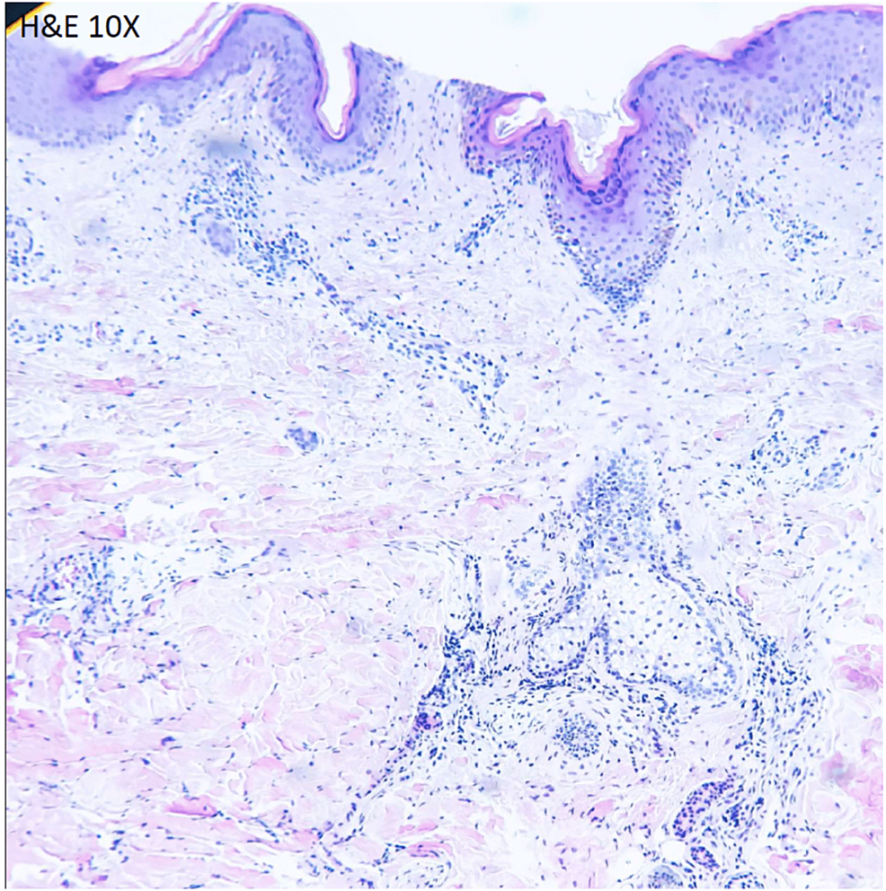 Cureus | Comprehensive Evaluation Of Neuropsychiatric And Mucocutaneous ...