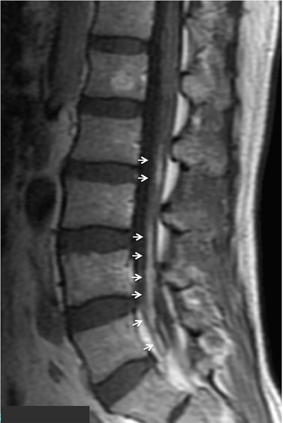 Cureus | Primary Central Nervous System Lymphoma with Peripheral Nerve ...