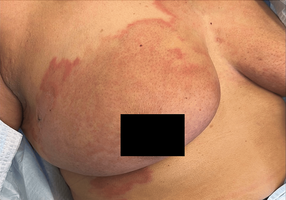 Breast rash 32 yr old female : r/DermatologyQuestions