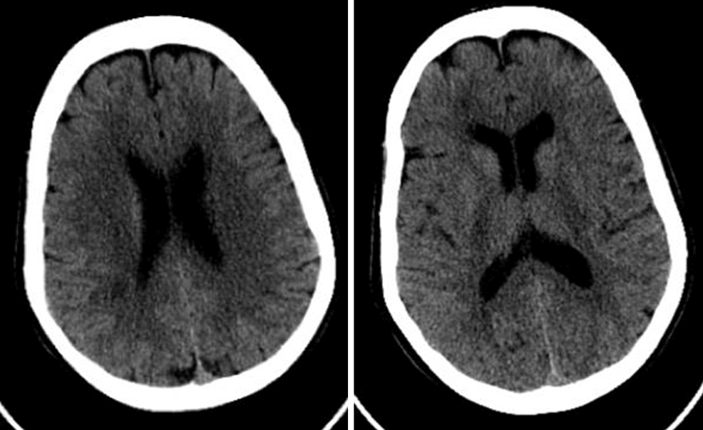 Prolonged neurological sequelae after combination treatment with lithium  and antipsychotic drugs.