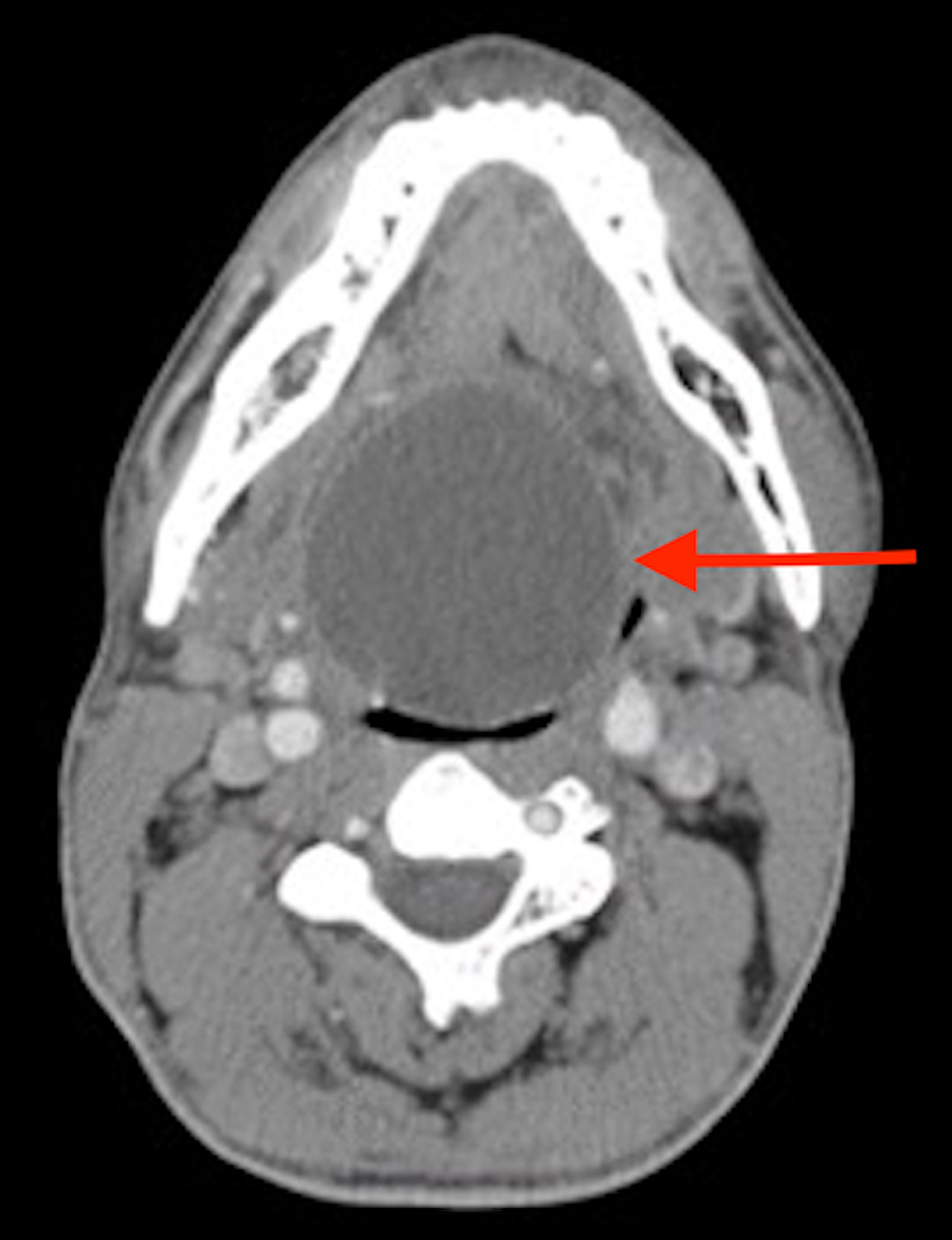 CT-image-of-the-mass-lodged-in-the-oropharynx,-as-indicated-by-the-red-arrow.-