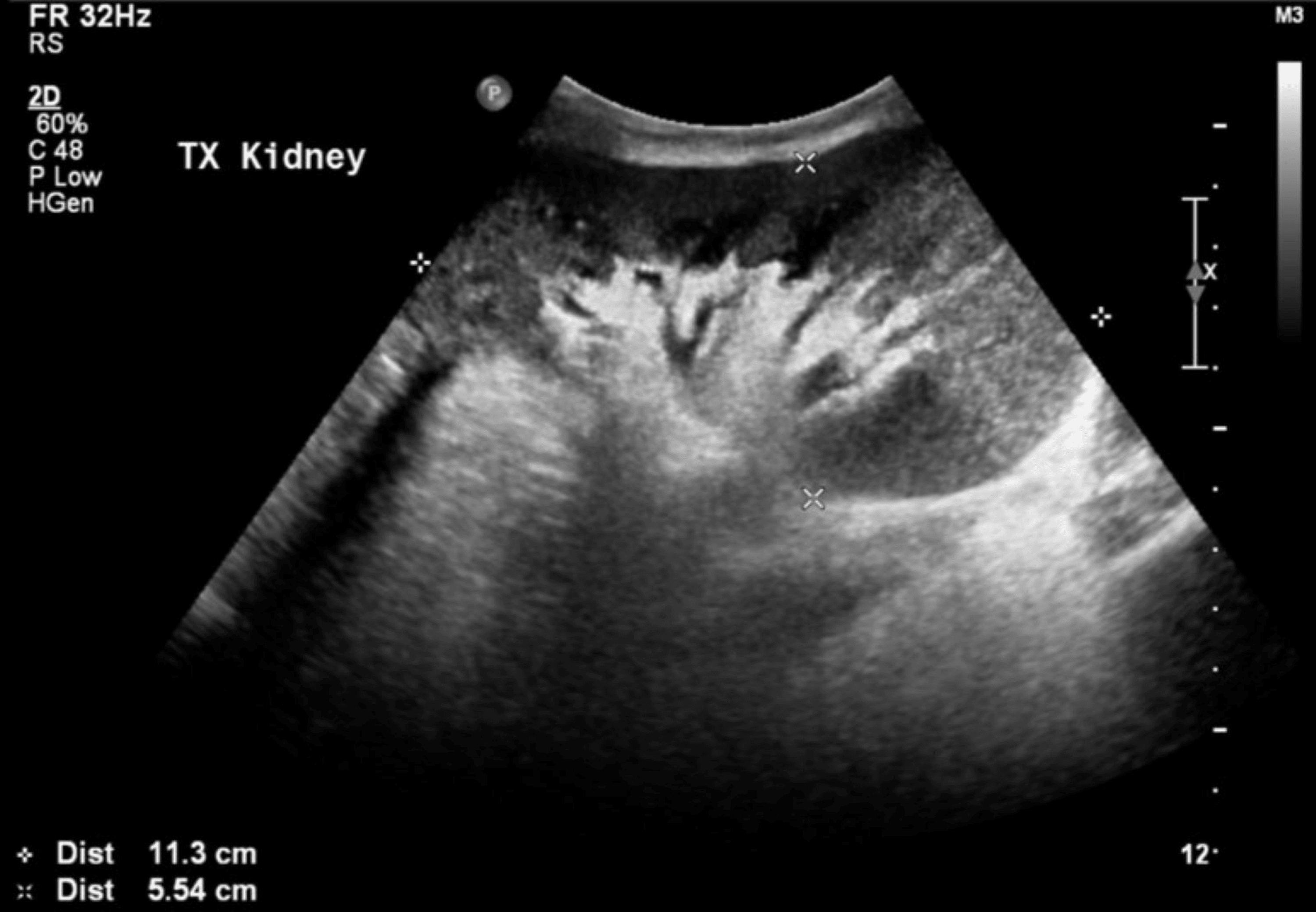 Pseudoaneurysm and Renal Artery Stenosis Postrenal Transplant A Rare