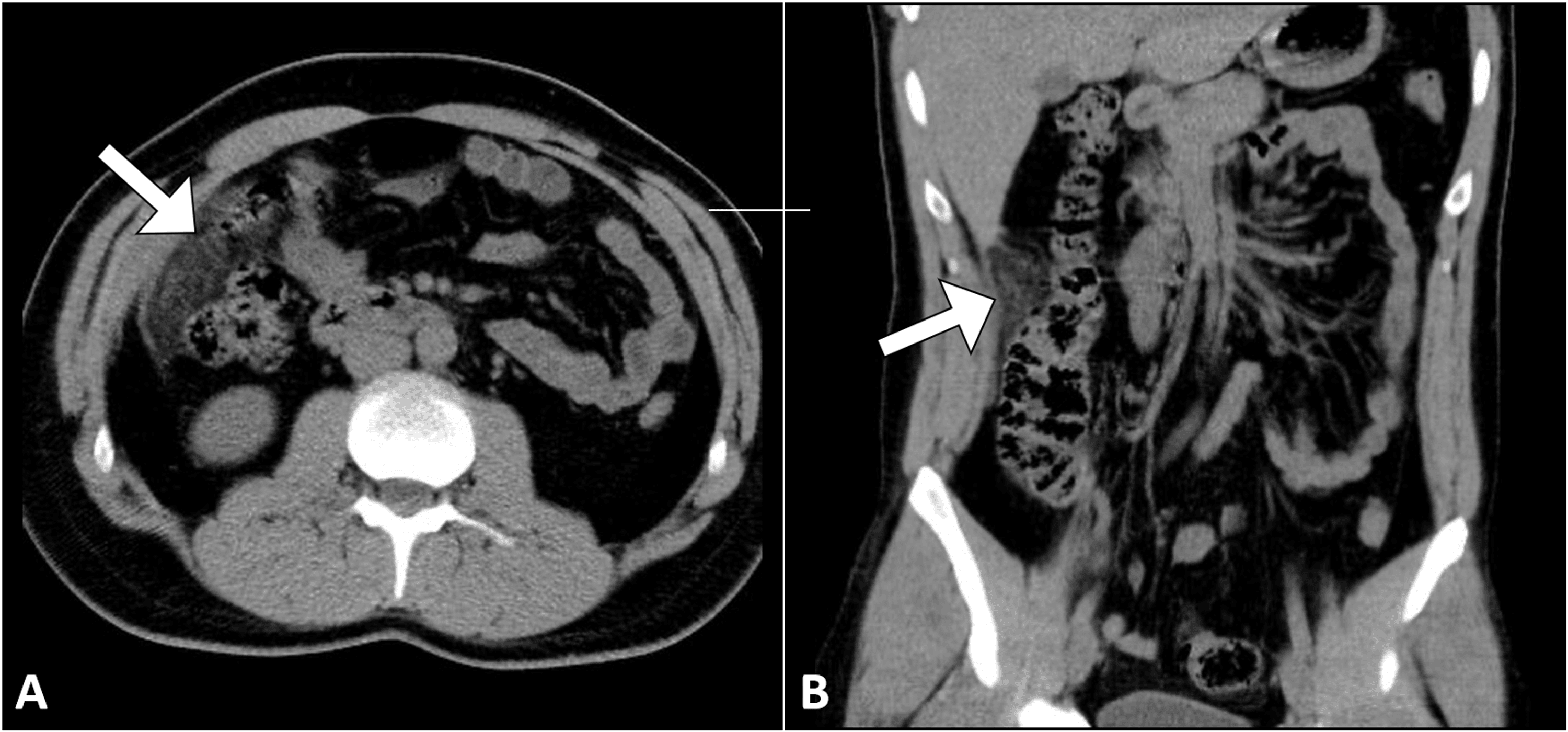 Cureus Omental Infarction Mimicking Acute Appendicitis A Case Report