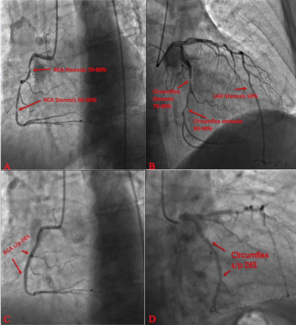 Cureus Vasospastic Angina and Role of Cardiac Catheterization