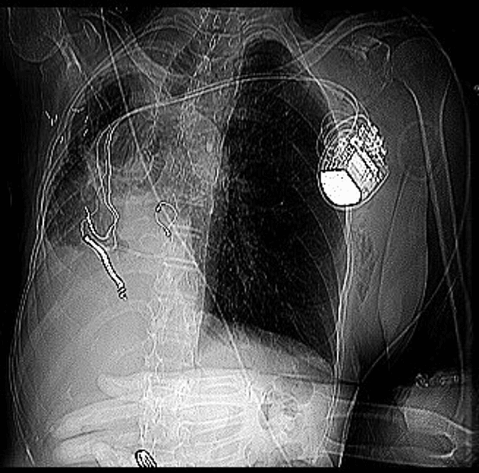 Cureus Placing a Biventricular Implantable Cardioverter Defibrillator