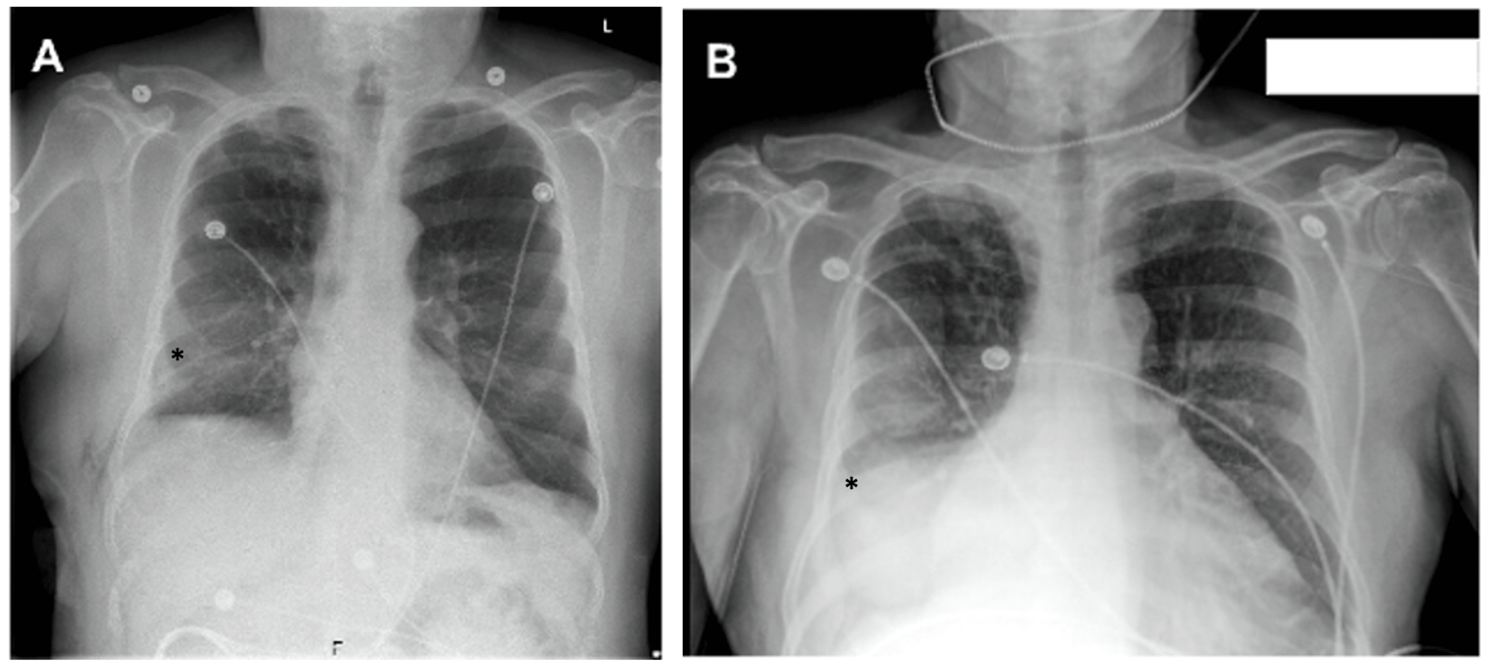 Traumatic Chylothorax Following Pulmonary Segmentectomy A Case Report