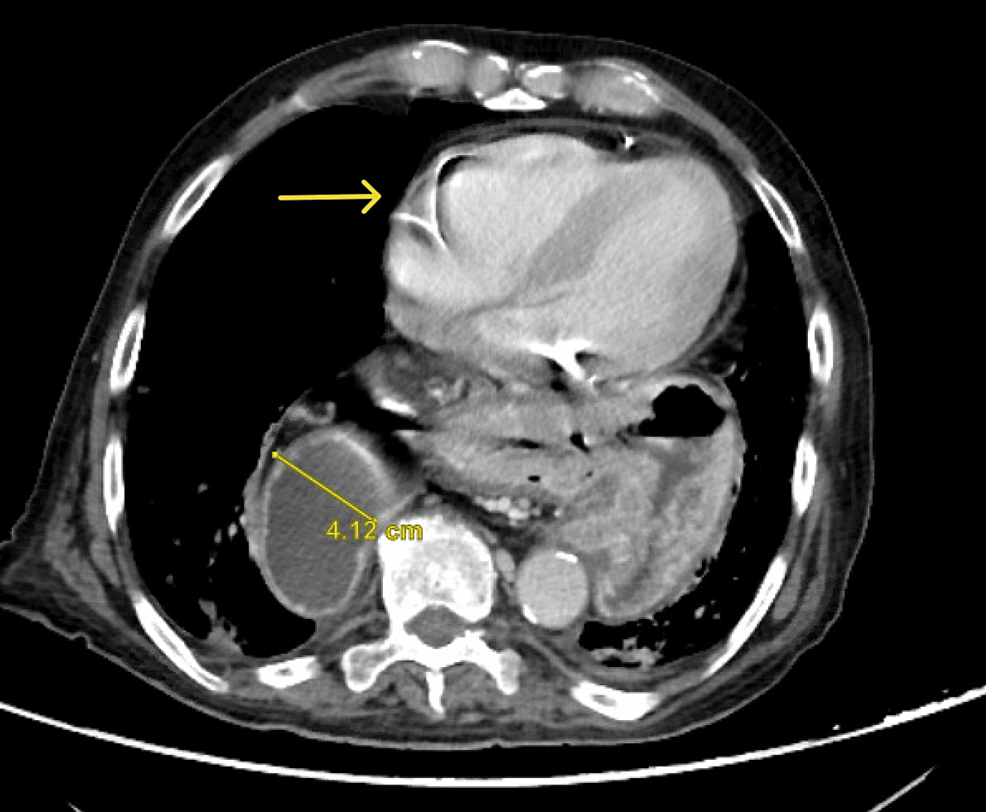 Cureus Laparoscopic Posterior Cruroplasty and Anterior Gastropexy for
