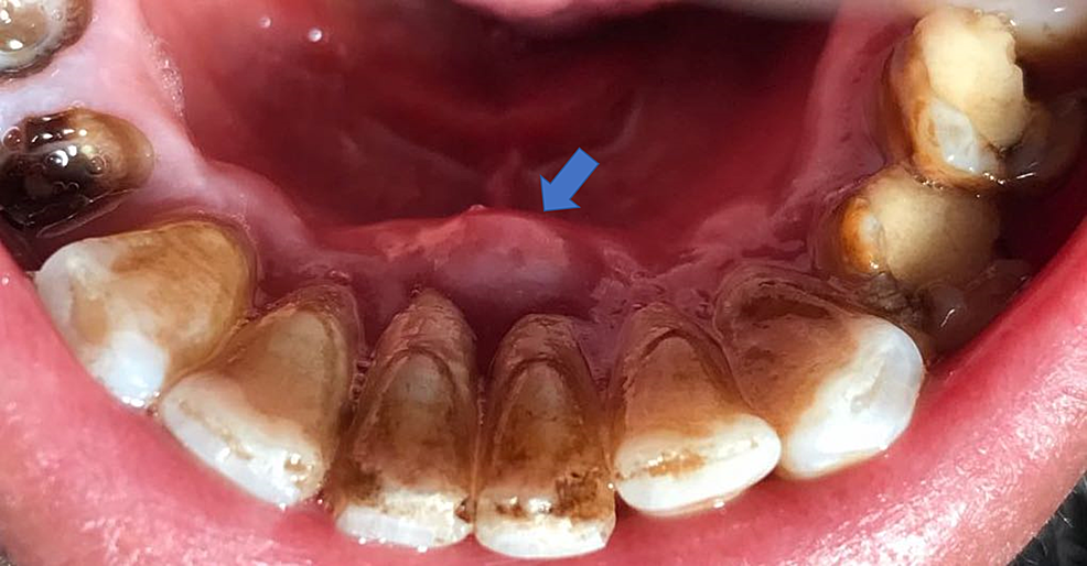 abscess gum