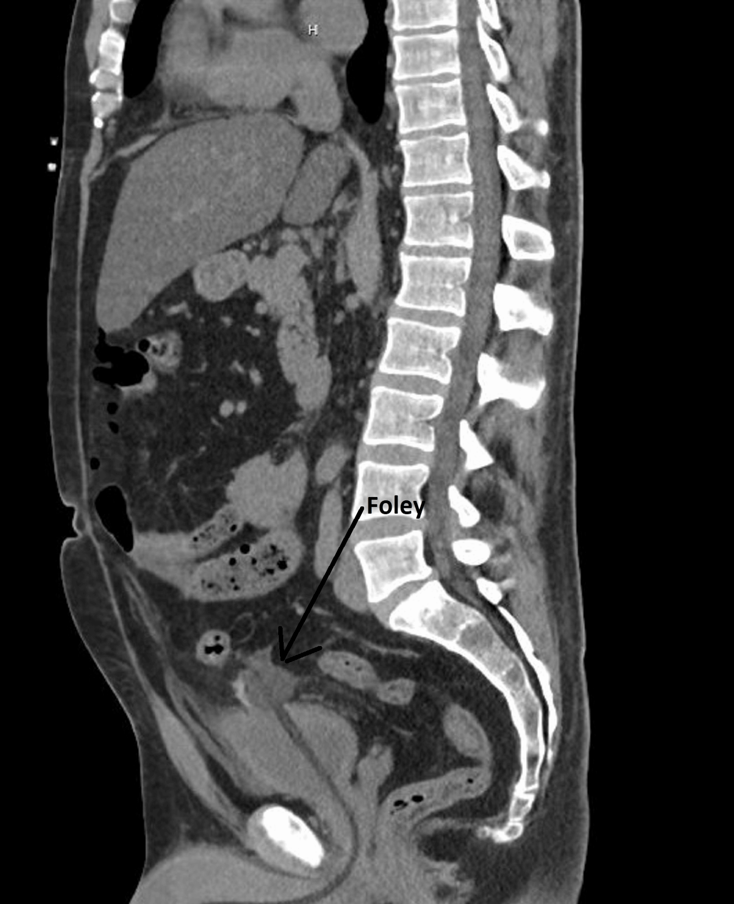 Spontaneous Bladder Rupture After Binge Drinking Cureus