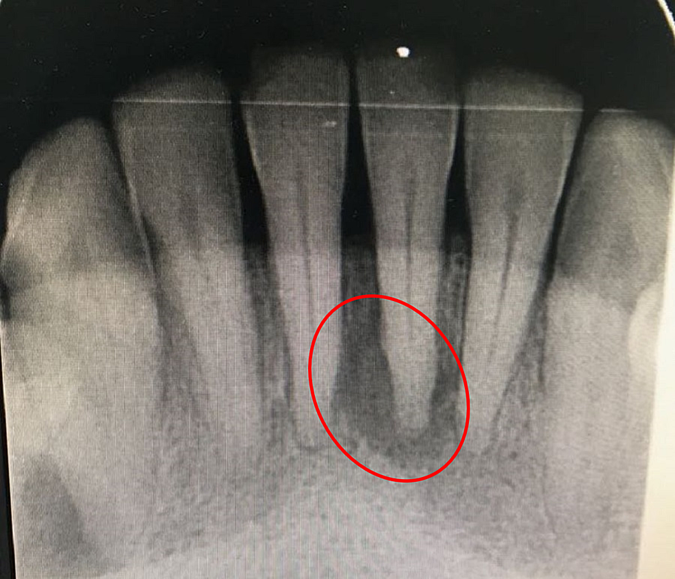 Cureus | Management of Acute Periodontal Abscess Mimicking Acute Apical