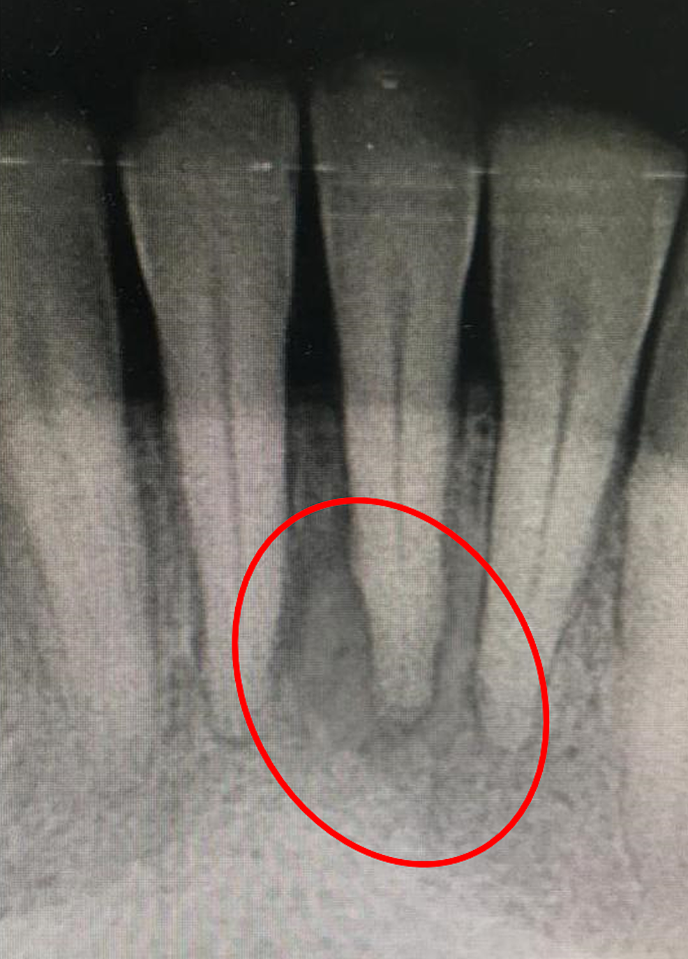 Cureus | Management of Acute Periodontal Abscess Mimicking Acute Apical